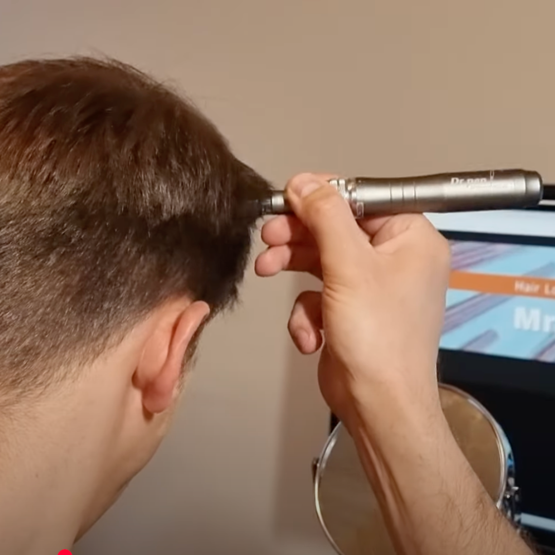 Hand holding one silver microneedling pen against the back of a person's short brown hair near the ear.