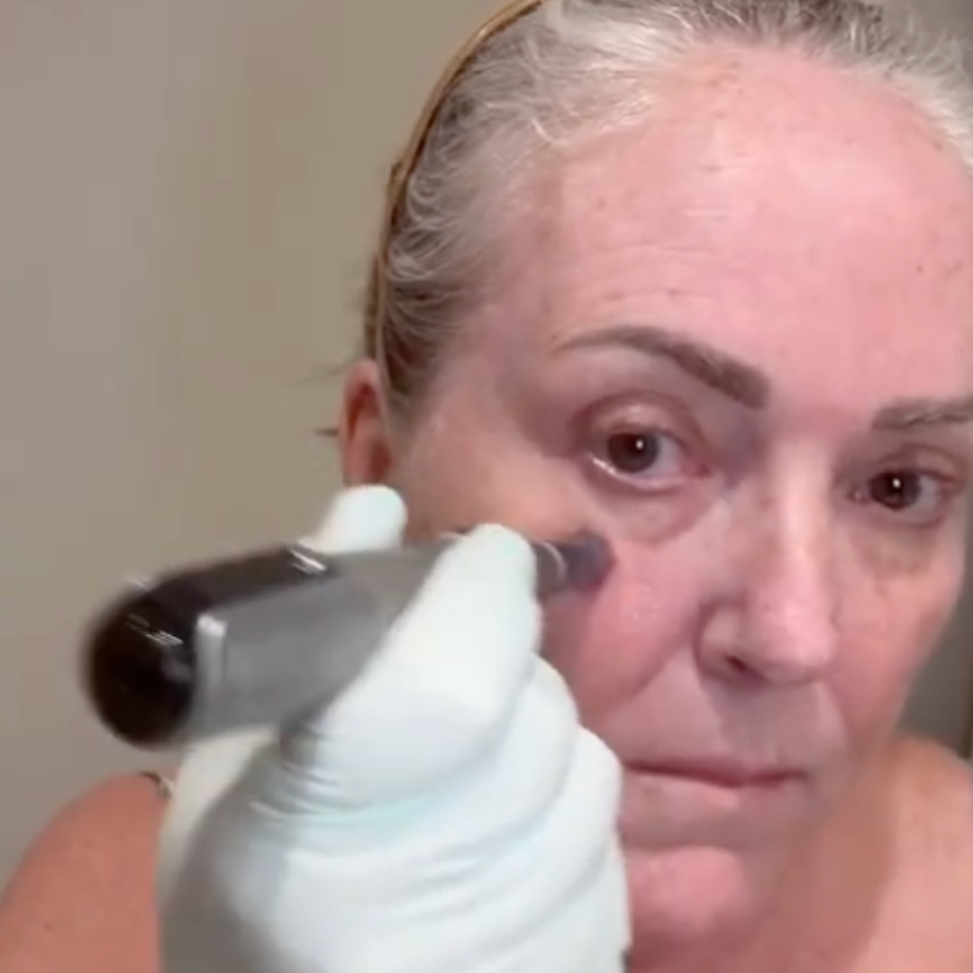 Gloved hand holding one silver microneedling pen against an older woman's cheek in a close face shot.