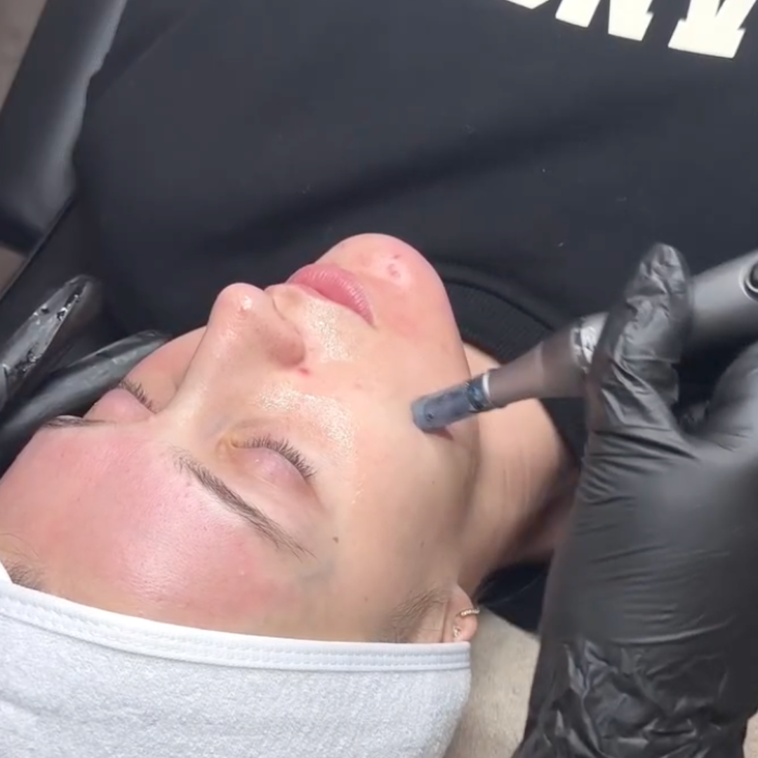 Close-up of one person's face with white headband undergoing microneedling from a gray pen held by a black-gloved hand.