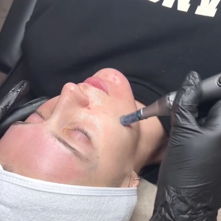 Close-up of one person's face with white headband undergoing microneedling from a gray pen held by a black-gloved hand.