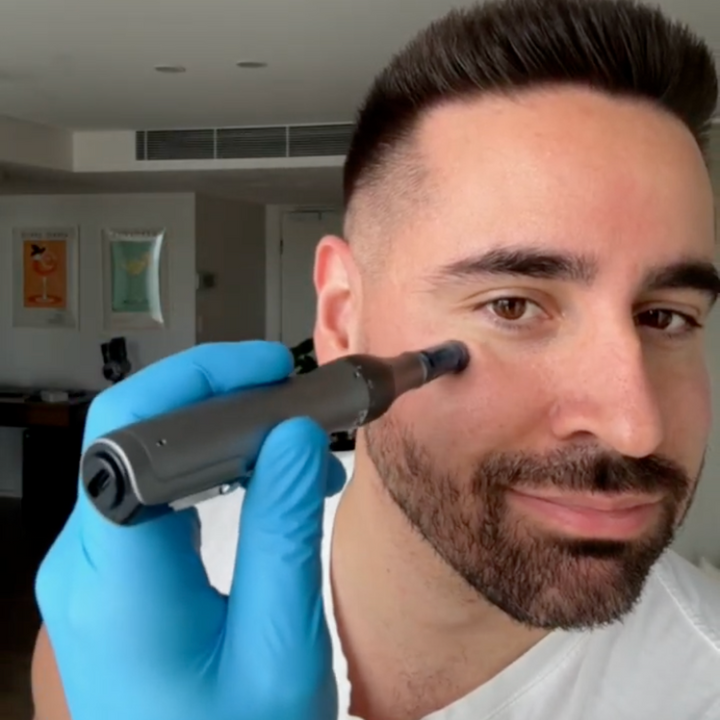 One blue-gloved hand holds a gray microneedling pen against a bearded man's right cheek.