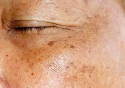 skin with sun damage and hyperpigmentation