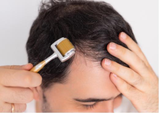 Scalp microneedling treatment at home using Derma Roller