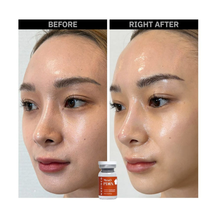 Medisco MesO PDRN before and right after treatment showing visibly smoother, glowing skin