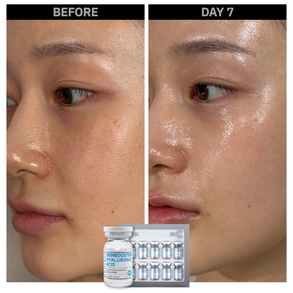 Before and after comparison of a woman's skin area after treatment with Skinbooster Hyaluronic Acid Ampoule. 