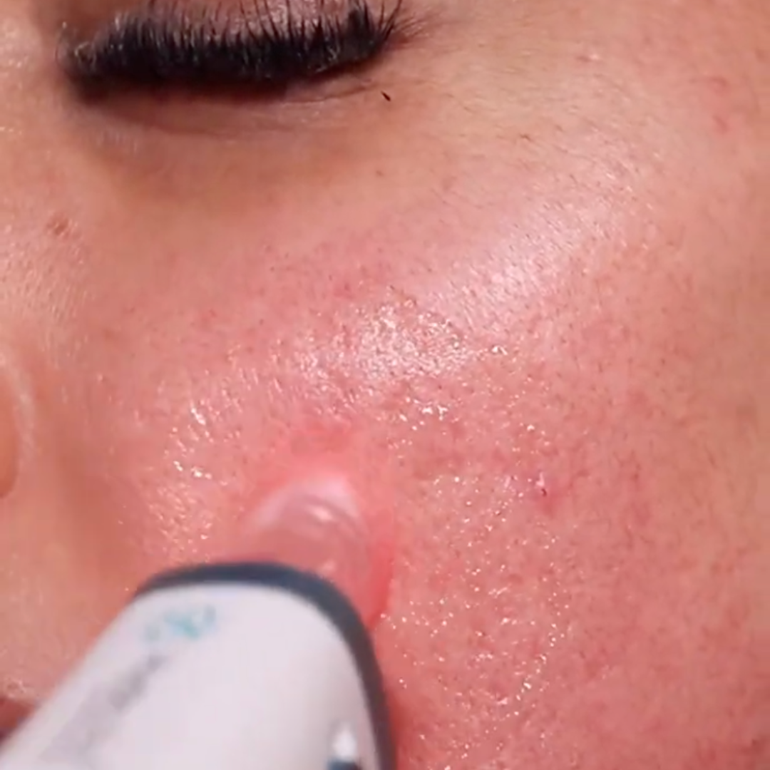 Close-up of the Dr. Pen H6 needle cartridge tip in contact with the skin during a microneedling treatment.